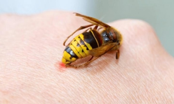 Дерматолог рассказала, что делать, если вас укусила оса